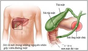Sỏi mật - Nguyên nhân, triệu chứng và cách điều trị